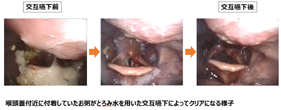 交互嚥下(とろみ水)を行った際の咽頭残留の変化