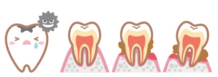 むし歯や歯周病 の増加 　